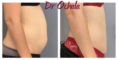 lipoaspiration
